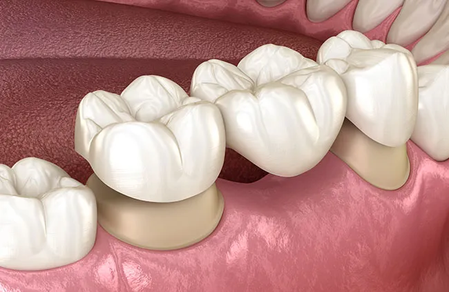 Quy trình làm răng sứ diễn ra như thế nào?