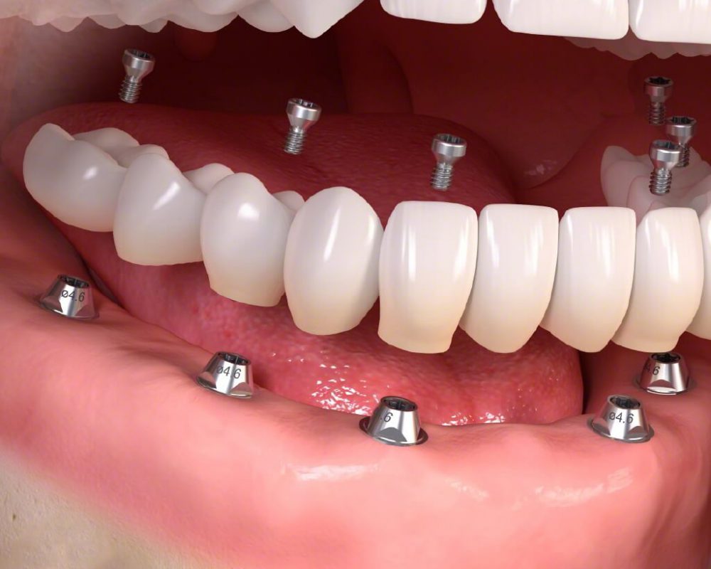 Bảo tồn răng gốc: Xu hướng mới trong nha khoa thẩm mỹ