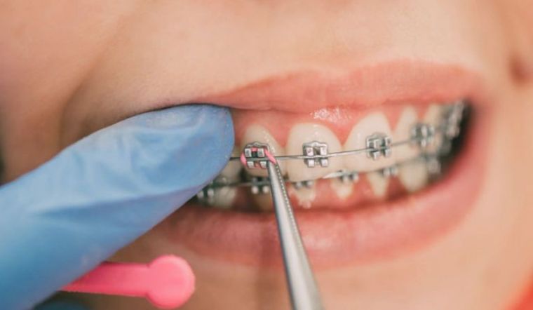 Những Trường Hợp Nên Niềng Răng Chỉnh Nha