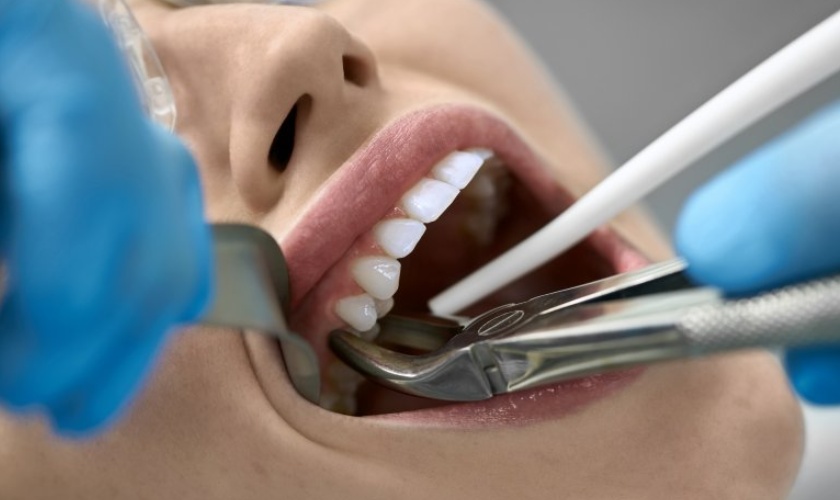 Nhổ răng số 4 bao lâu thì lành? 4 yếu tố ảnh hưởng đến thời gian lành thương sau khi nhổ răng